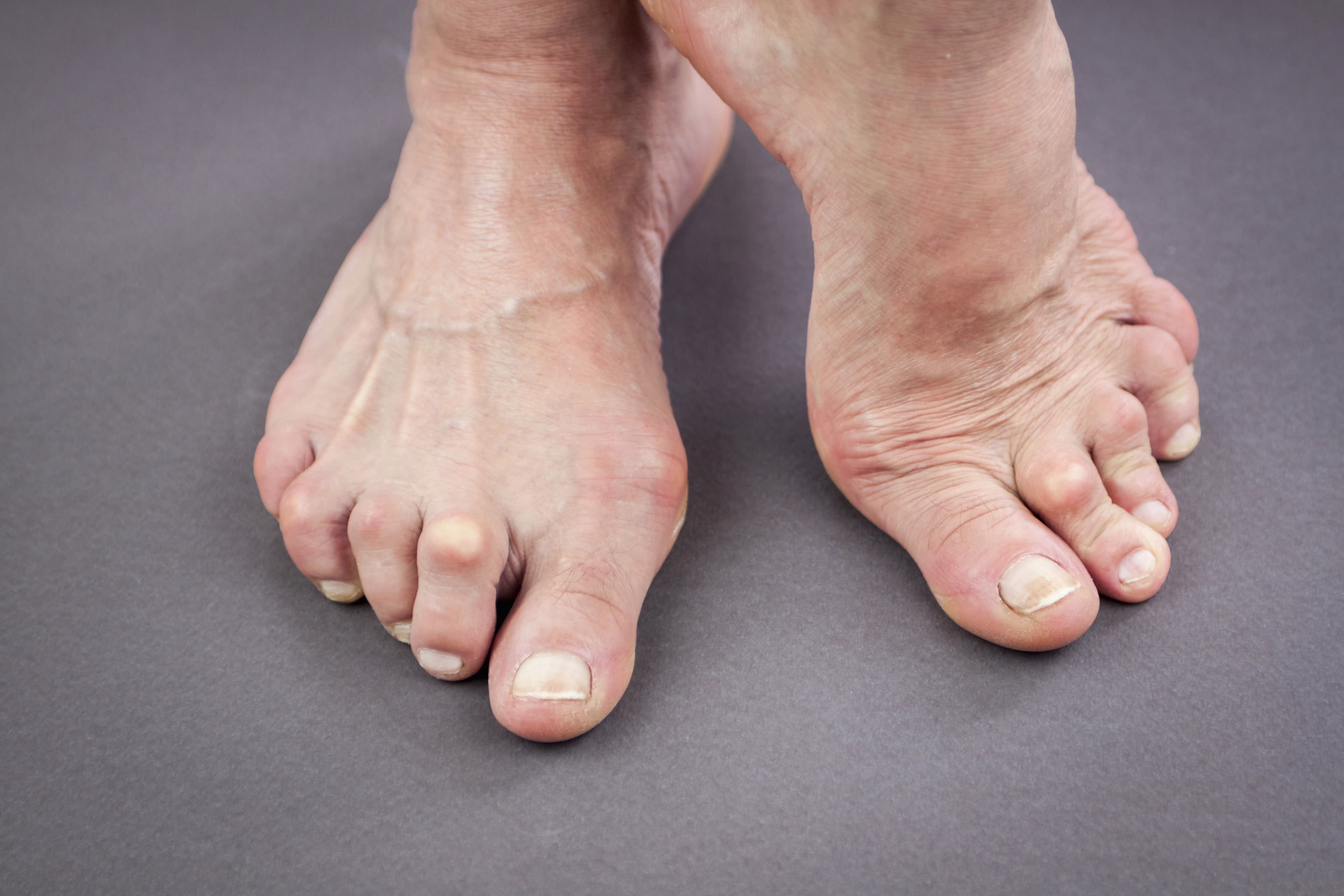 Close-up of bare feet with severe bunions and hammer toes on a neutral gray surface.