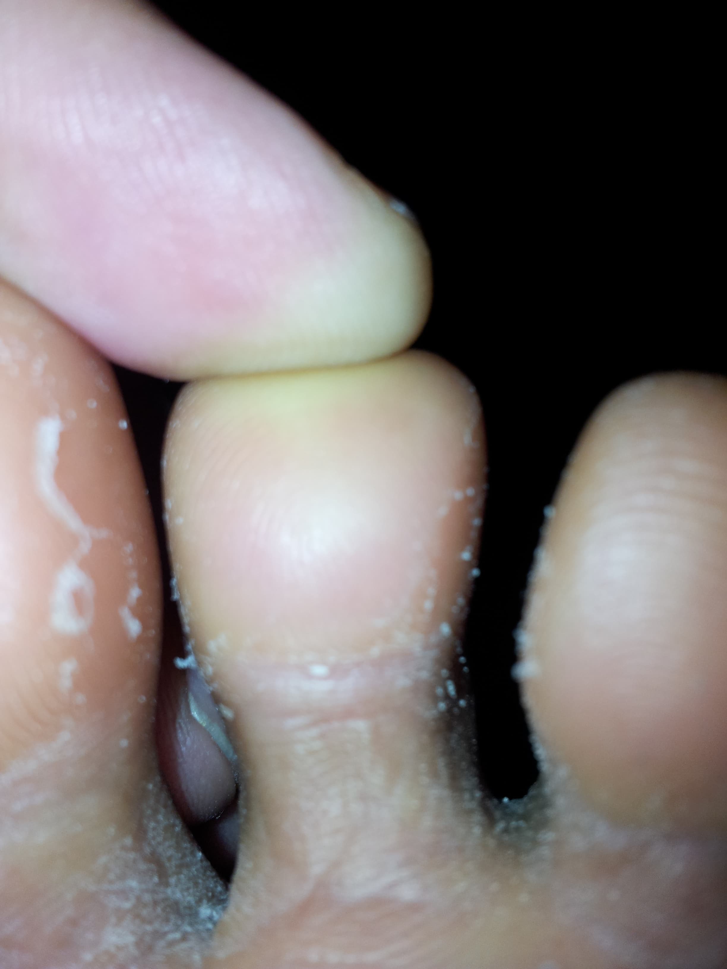 Close-up of toes with peeling skin and white flaky patches, with a finger pressing.