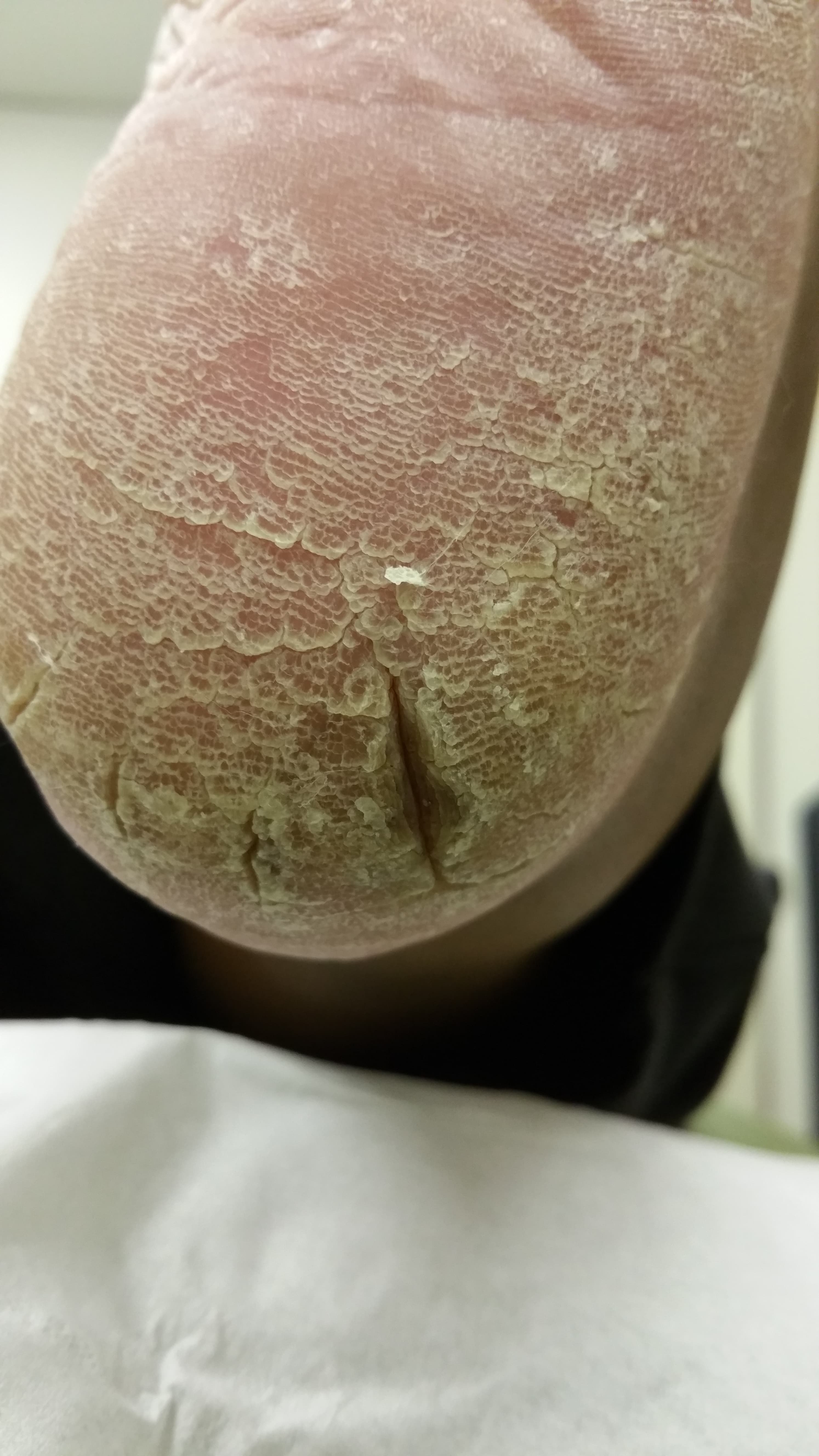Close-up of an extremely dry human heel with thickened, flaky skin and deep cracks.