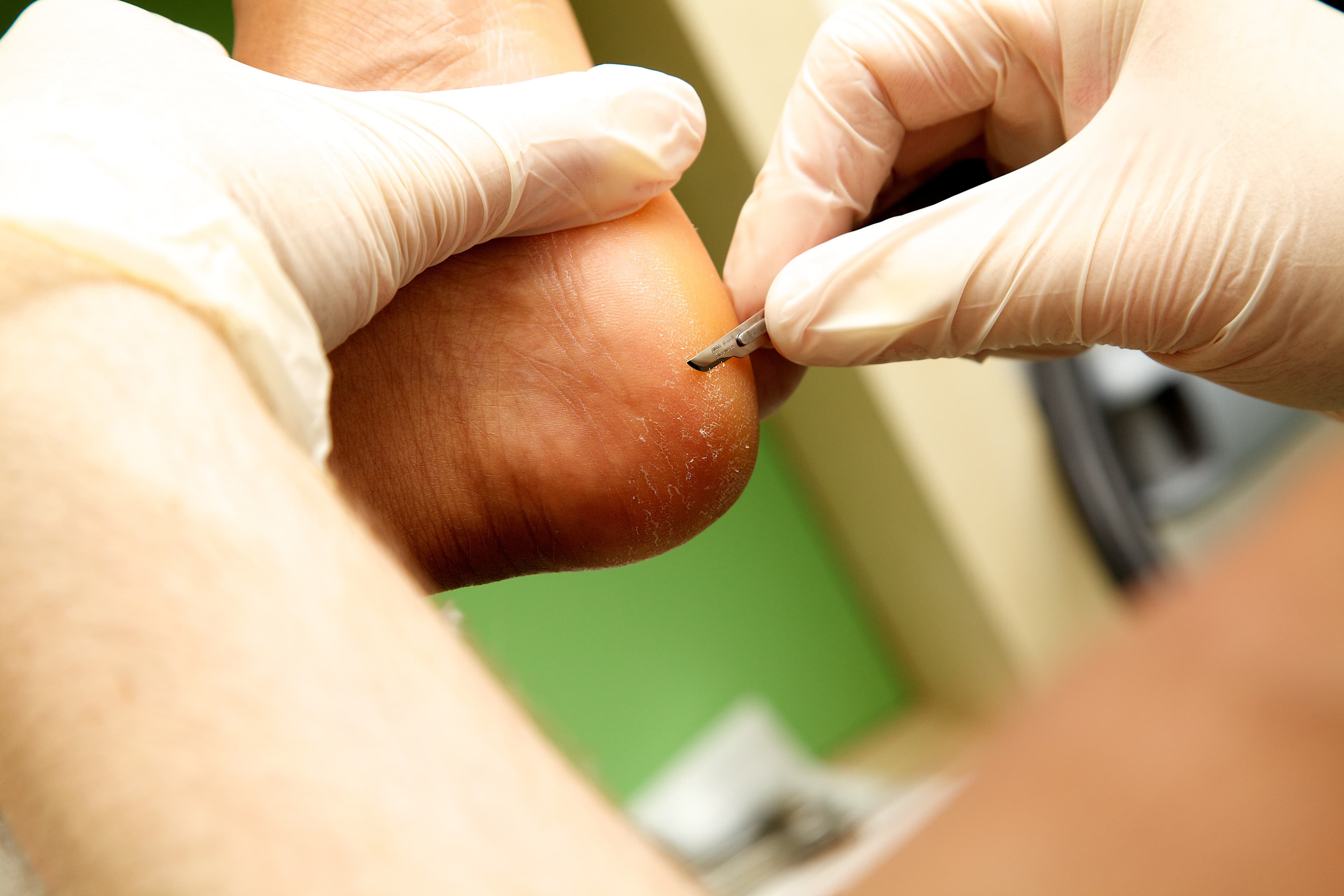 Gloved hands using a scalpel to remove dry, calloused skin from a person's heel.