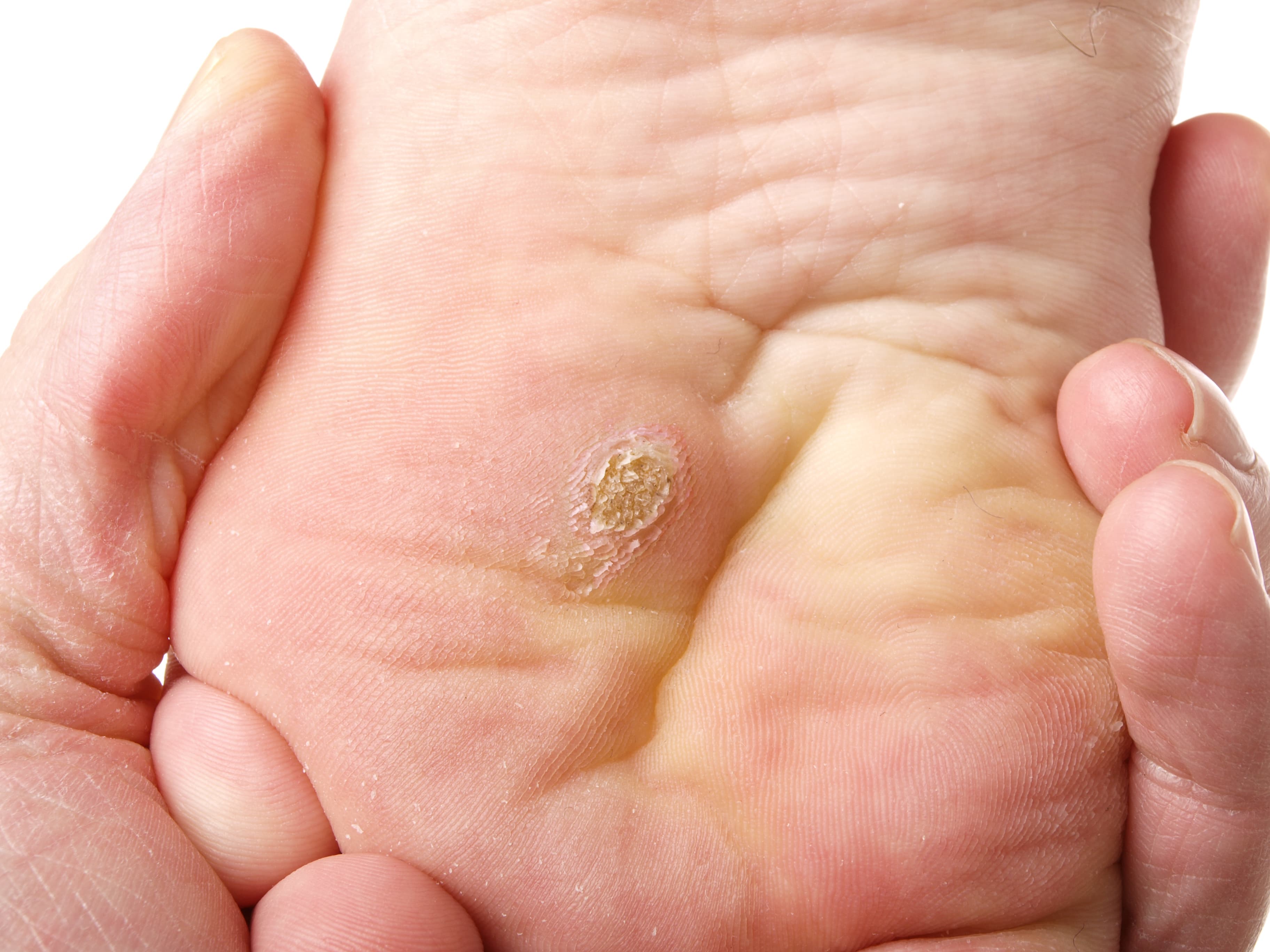 A rough plantar wart on the sole of a foot held by a hand.